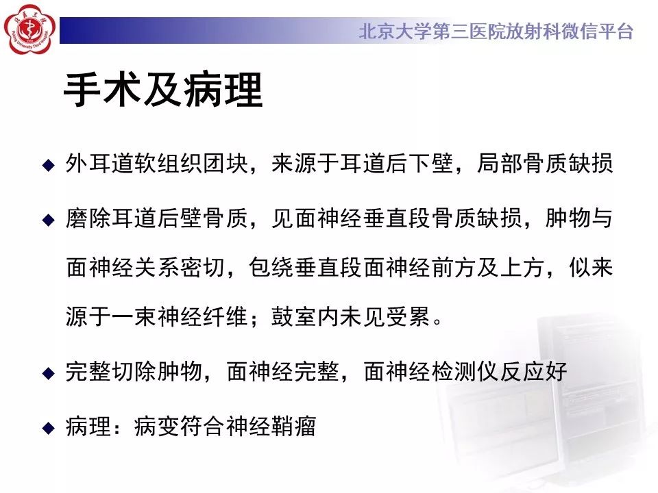 【病例】面神经鞘瘤1例CT及MR影像