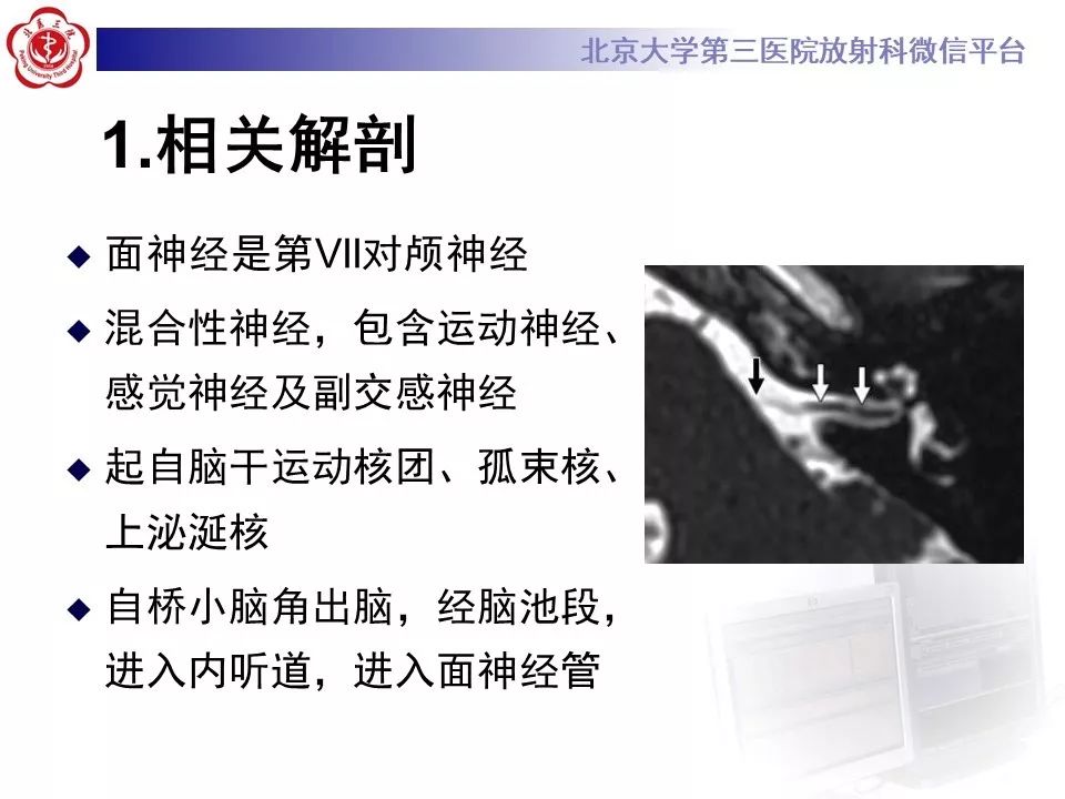 【病例】面神经鞘瘤1例CT及MR影像