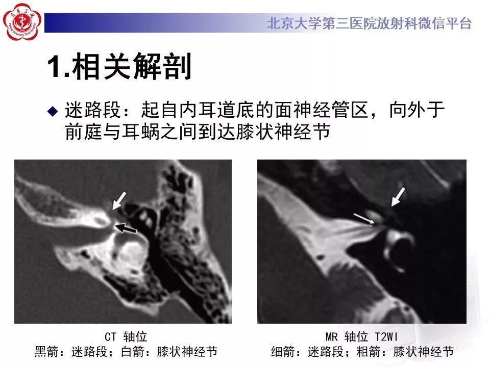 【病例】面神经鞘瘤1例CT及MR影像