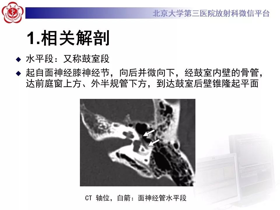 【病例】面神经鞘瘤1例CT及MR影像