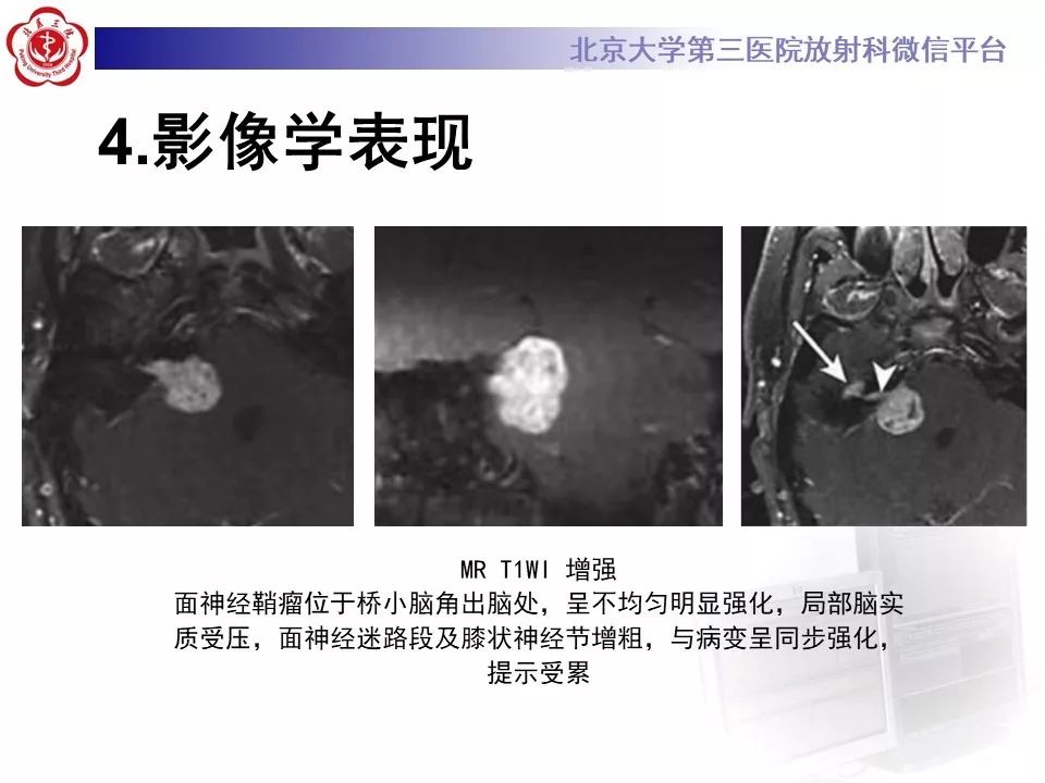【病例】面神经鞘瘤1例CT及MR影像
