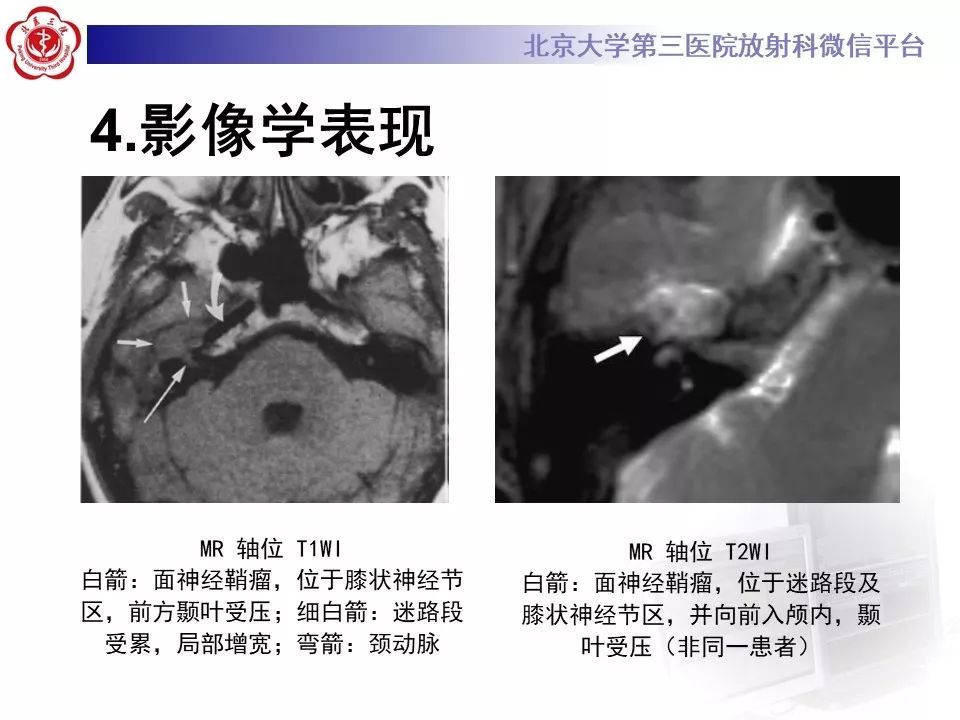 【病例】面神经鞘瘤1例CT及MR影像