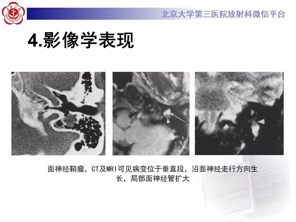 【病例】面神经鞘瘤1例CT及MR影像