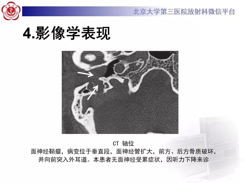 【病例】面神经鞘瘤1例CT及MR影像
