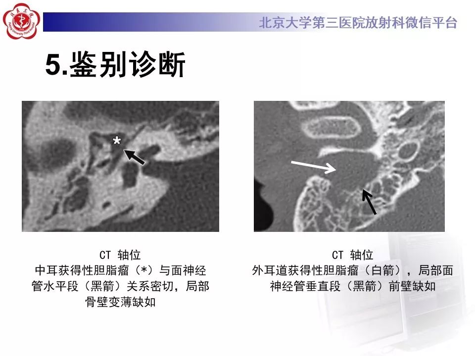 【病例】面神经鞘瘤1例CT及MR影像