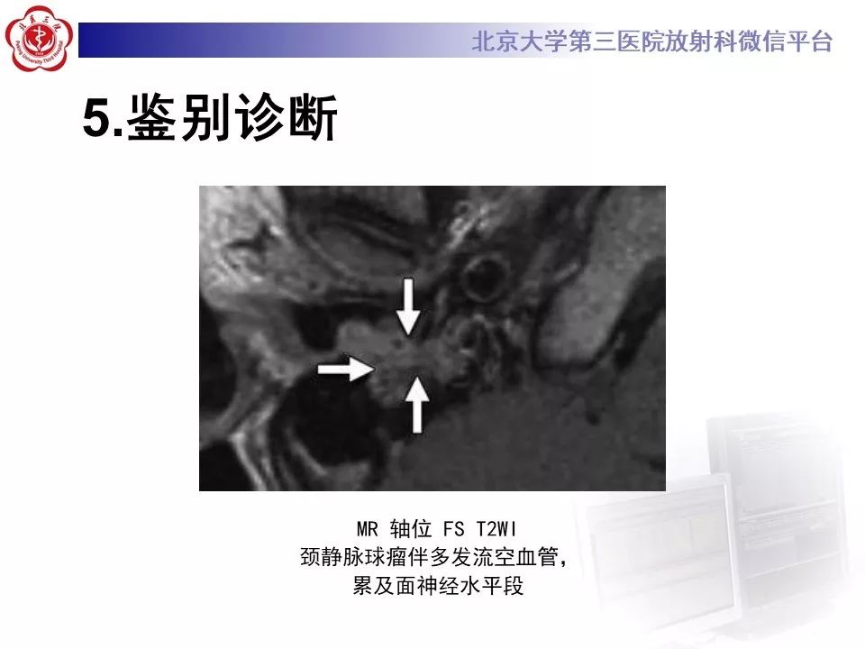 【病例】面神经鞘瘤1例CT及MR影像