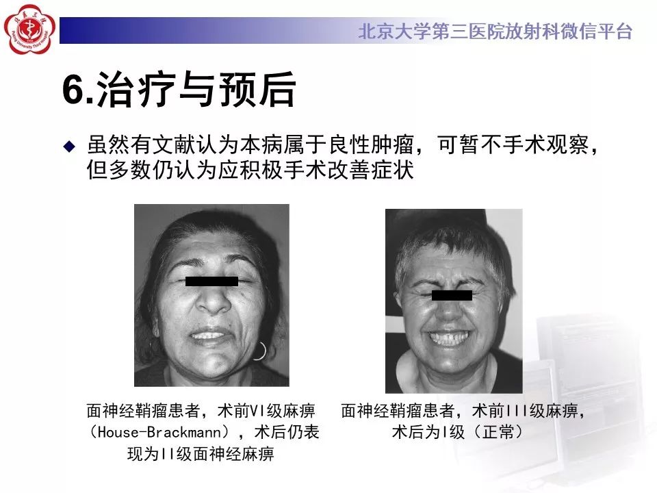 【病例】面神经鞘瘤1例CT及MR影像