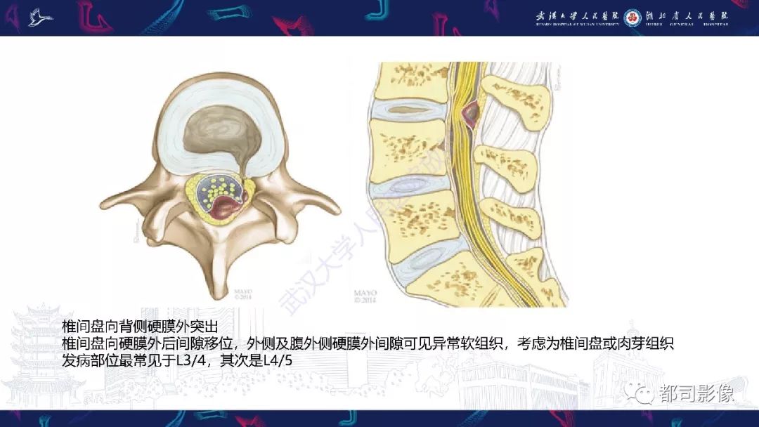 【PPT】椎间盘不常见病变影像诊断