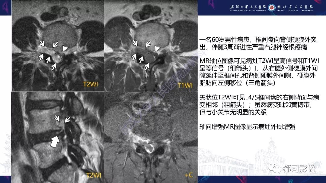 【PPT】椎间盘不常见病变影像诊断