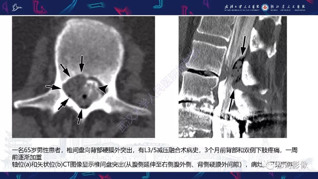 【PPT】椎间盘不常见病变影像诊断