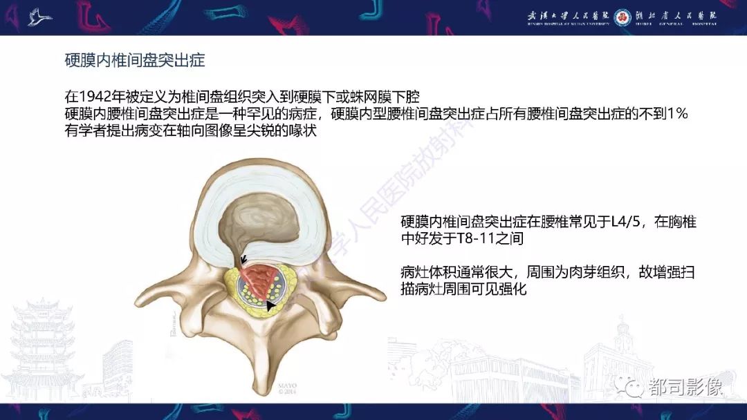 【PPT】椎间盘不常见病变影像诊断