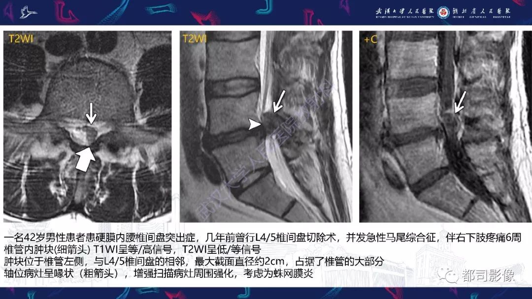 【PPT】椎间盘不常见病变影像诊断