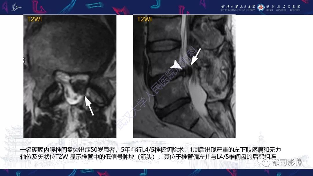 【PPT】椎间盘不常见病变影像诊断