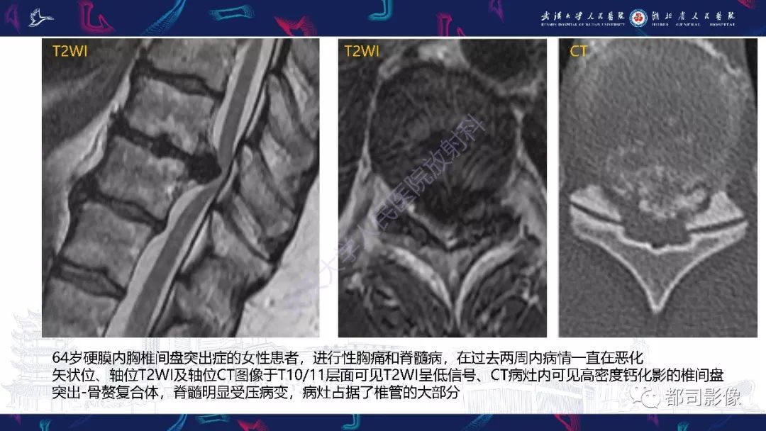 【PPT】椎间盘不常见病变影像诊断