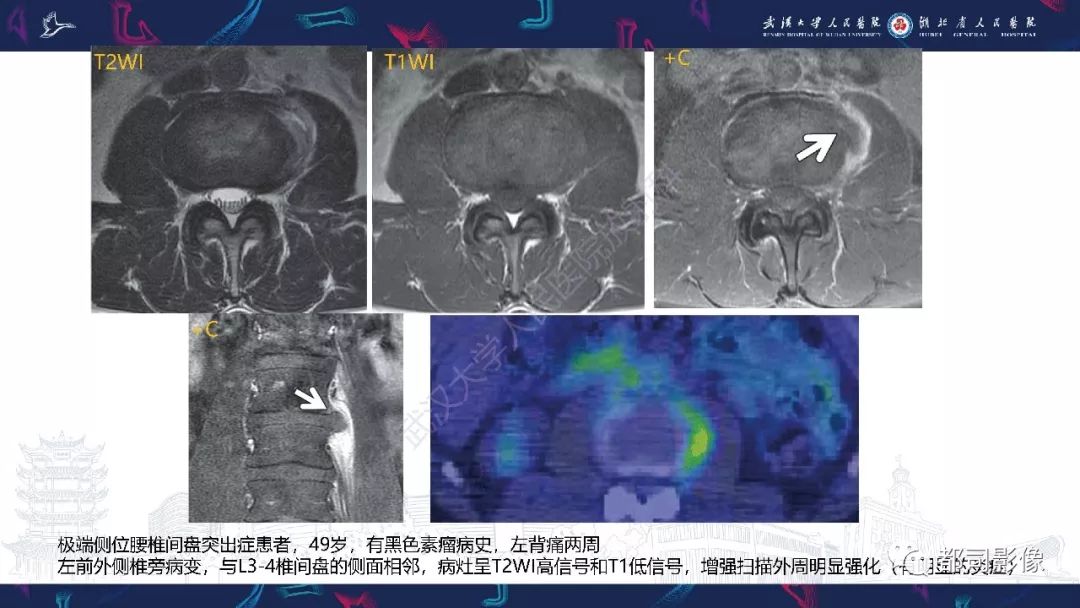 【PPT】椎间盘不常见病变影像诊断