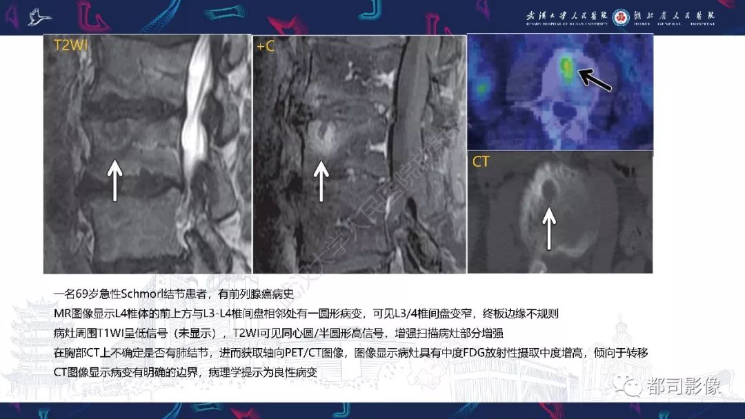 【PPT】椎间盘不常见病变影像诊断
