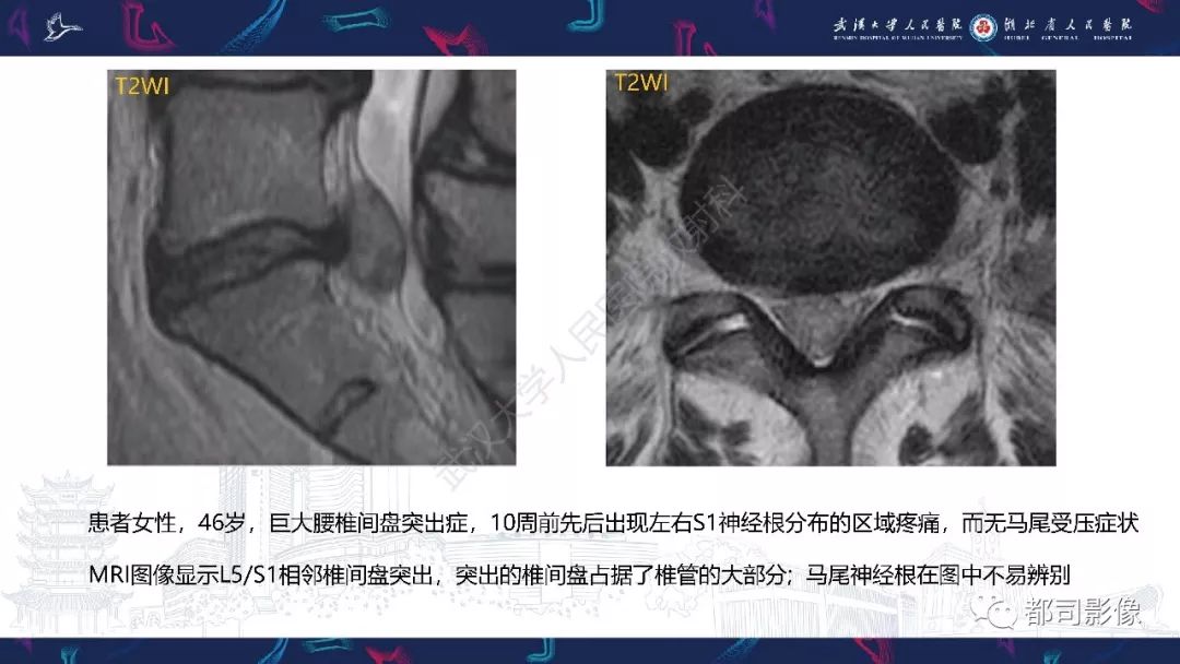 【PPT】椎间盘不常见病变影像诊断
