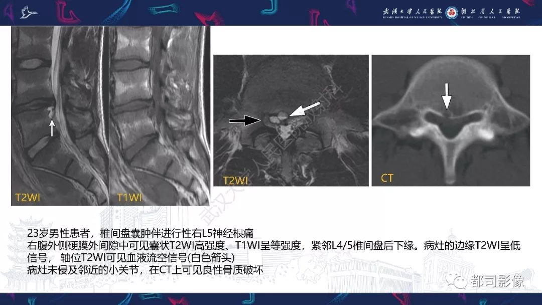 【PPT】椎间盘不常见病变影像诊断