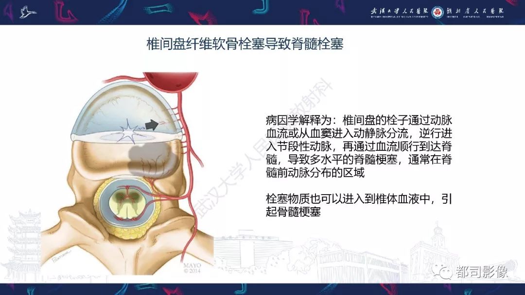 【PPT】椎间盘不常见病变影像诊断