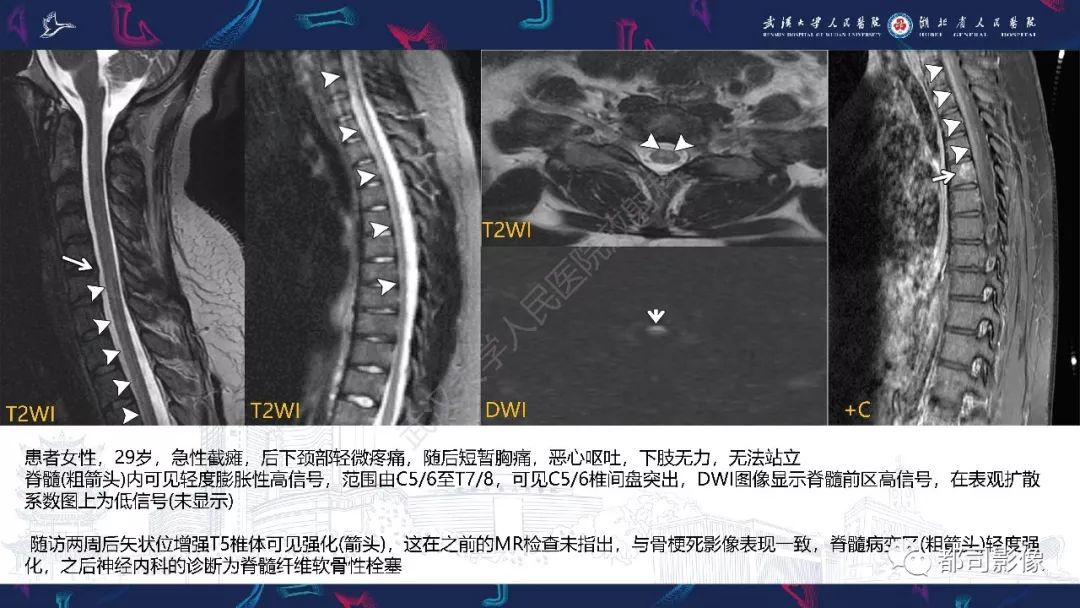 【PPT】椎间盘不常见病变影像诊断