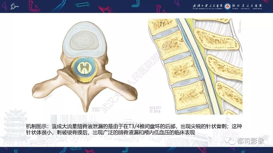 【PPT】椎间盘不常见病变影像诊断
