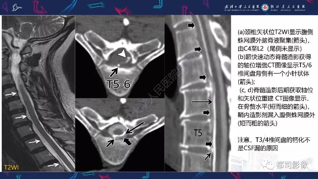 【PPT】椎间盘不常见病变影像诊断