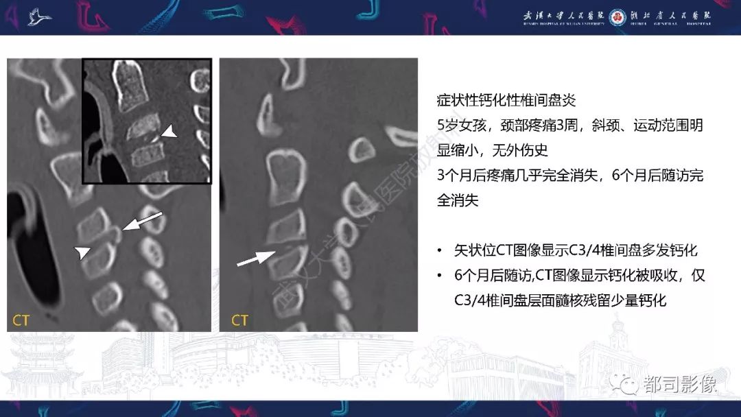 【PPT】椎间盘不常见病变影像诊断