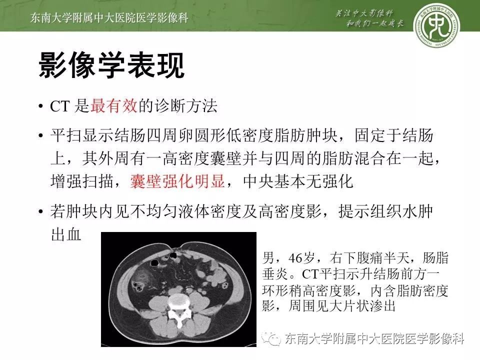 【病例】肠脂垂炎1例CT影像