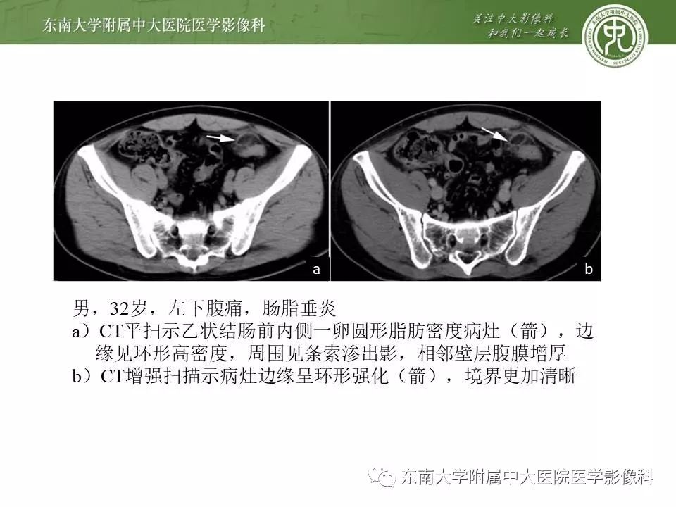 【病例】肠脂垂炎1例CT影像