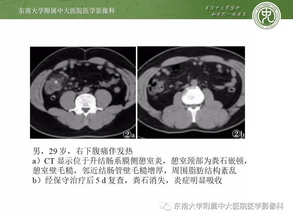 【病例】肠脂垂炎1例CT影像
