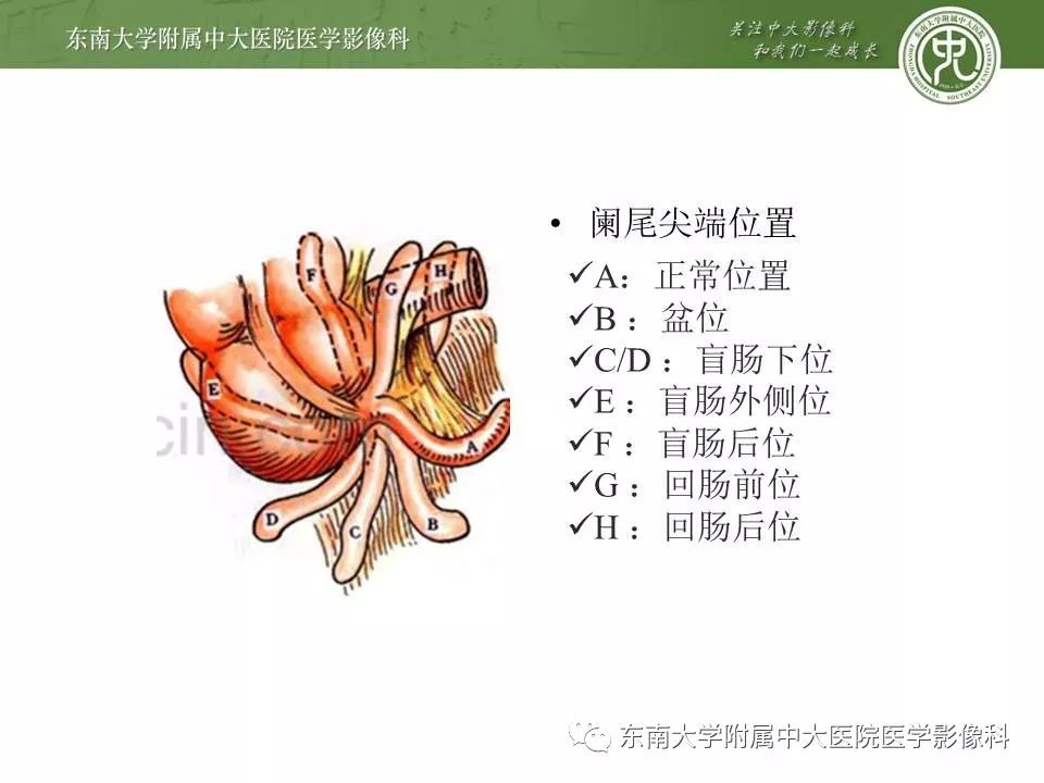【病例】肠脂垂炎1例CT影像