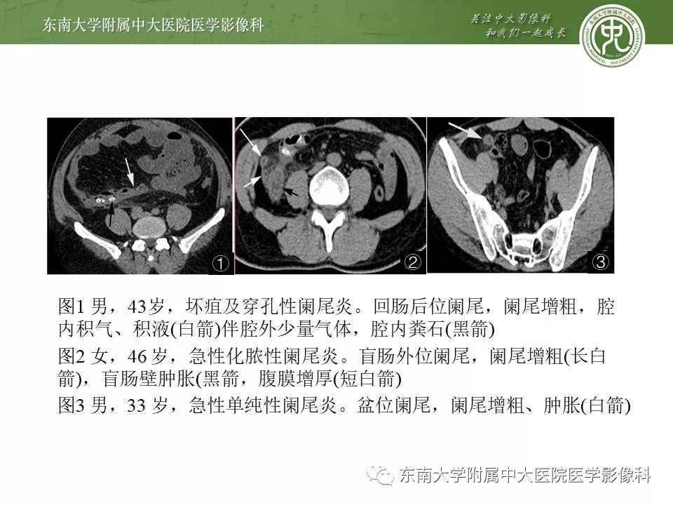 【病例】肠脂垂炎1例CT影像