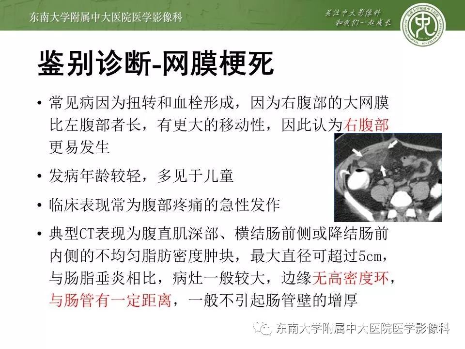 【病例】肠脂垂炎1例CT影像