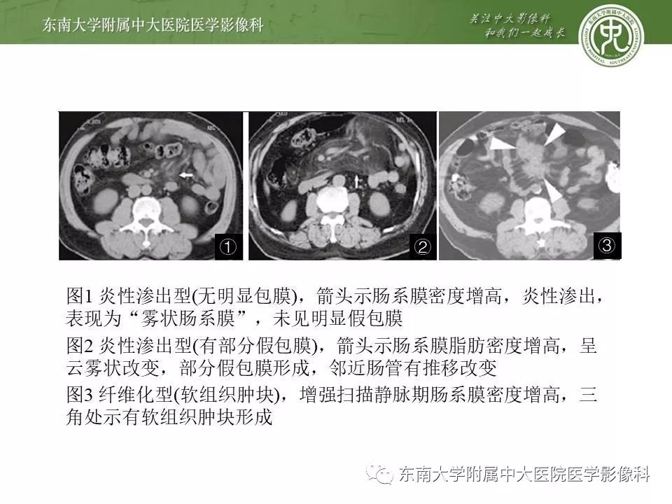 【病例】肠脂垂炎1例CT影像