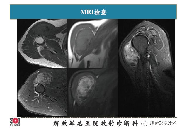 【PPT】软组织肿瘤磁共振诊断分析思路