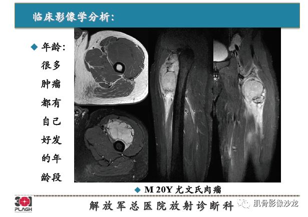 【PPT】软组织肿瘤磁共振诊断分析思路