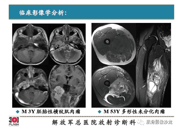 【PPT】软组织肿瘤磁共振诊断分析思路