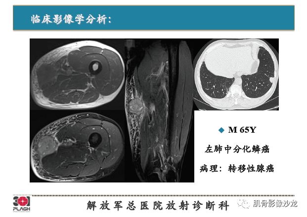 【PPT】软组织肿瘤磁共振诊断分析思路