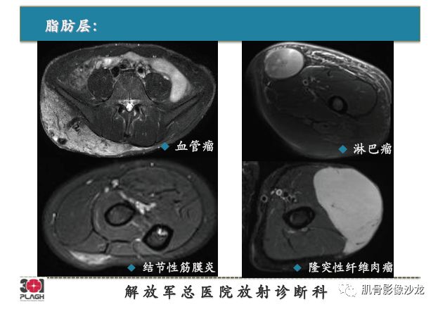 【PPT】软组织肿瘤磁共振诊断分析思路