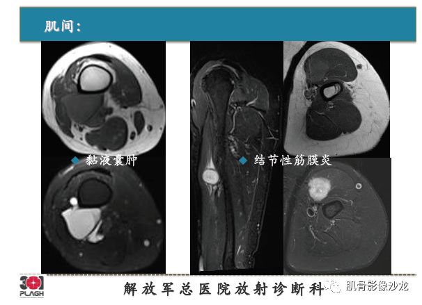 【PPT】软组织肿瘤磁共振诊断分析思路