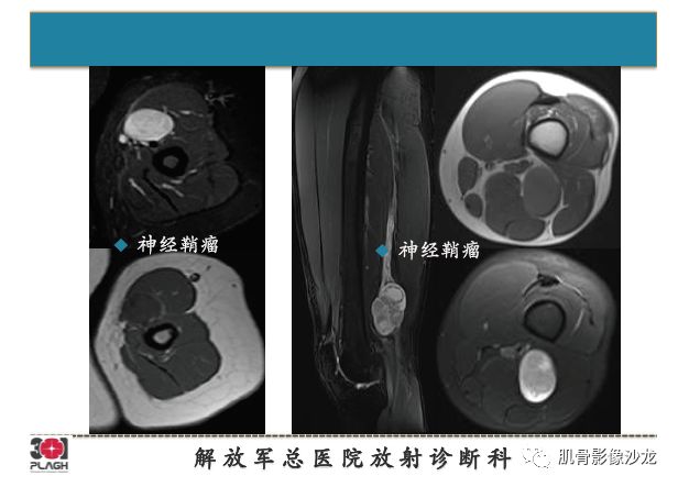 【PPT】软组织肿瘤磁共振诊断分析思路
