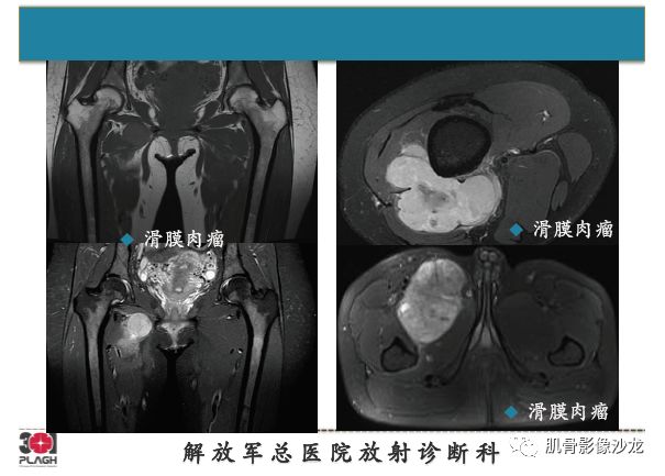 【PPT】软组织肿瘤磁共振诊断分析思路