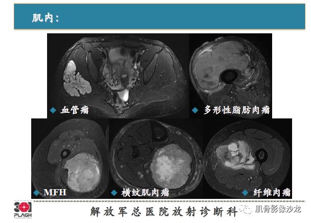 【PPT】软组织肿瘤磁共振诊断分析思路