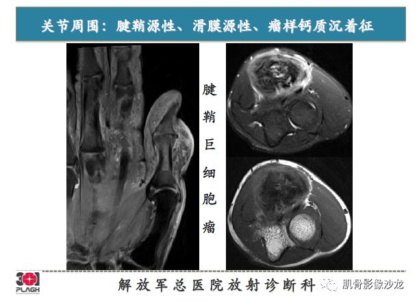 【PPT】软组织肿瘤磁共振诊断分析思路