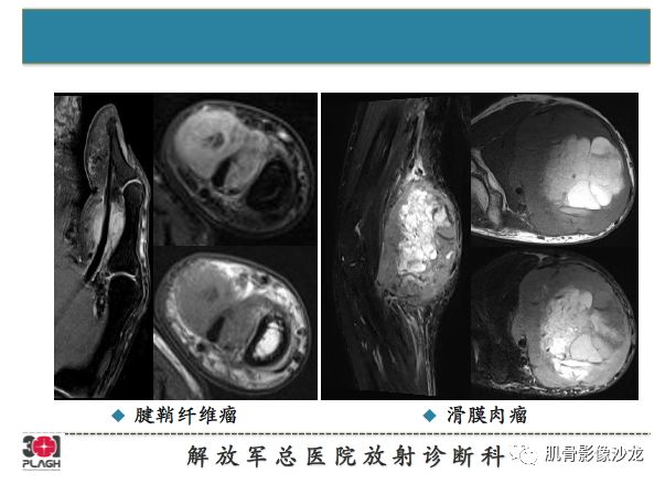 【PPT】软组织肿瘤磁共振诊断分析思路