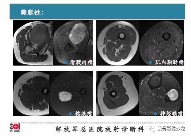 【PPT】软组织肿瘤磁共振诊断分析思路