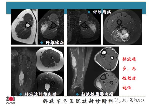 【PPT】软组织肿瘤磁共振诊断分析思路