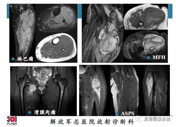 【PPT】软组织肿瘤磁共振诊断分析思路