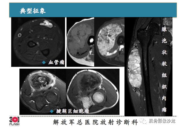 【PPT】软组织肿瘤磁共振诊断分析思路