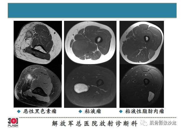 【PPT】软组织肿瘤磁共振诊断分析思路